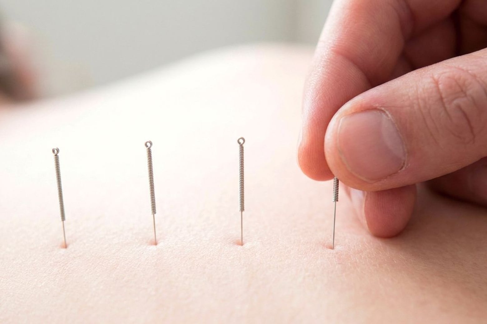 Fine acupuncture needles being placed along a patient's spine.